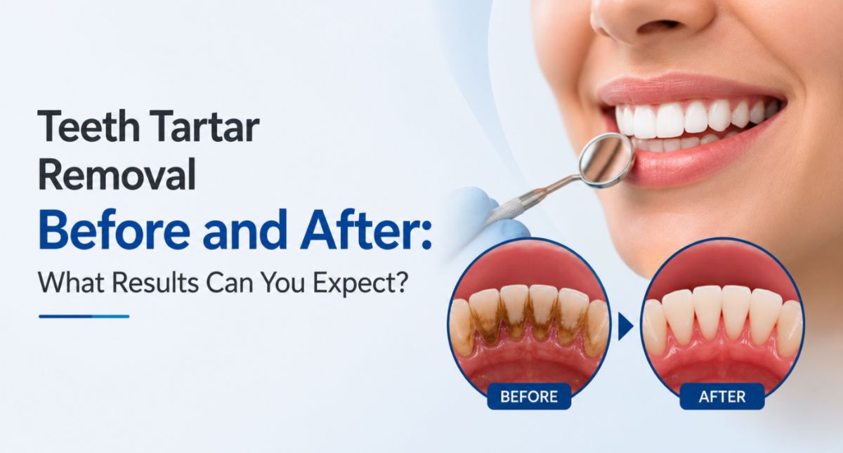 Teeth Tartar Removal