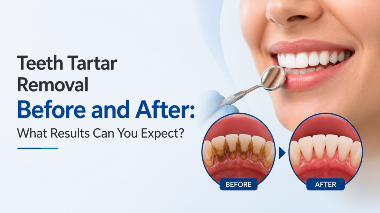 Teeth Tartar Removal Before and After What Results Can You Expect