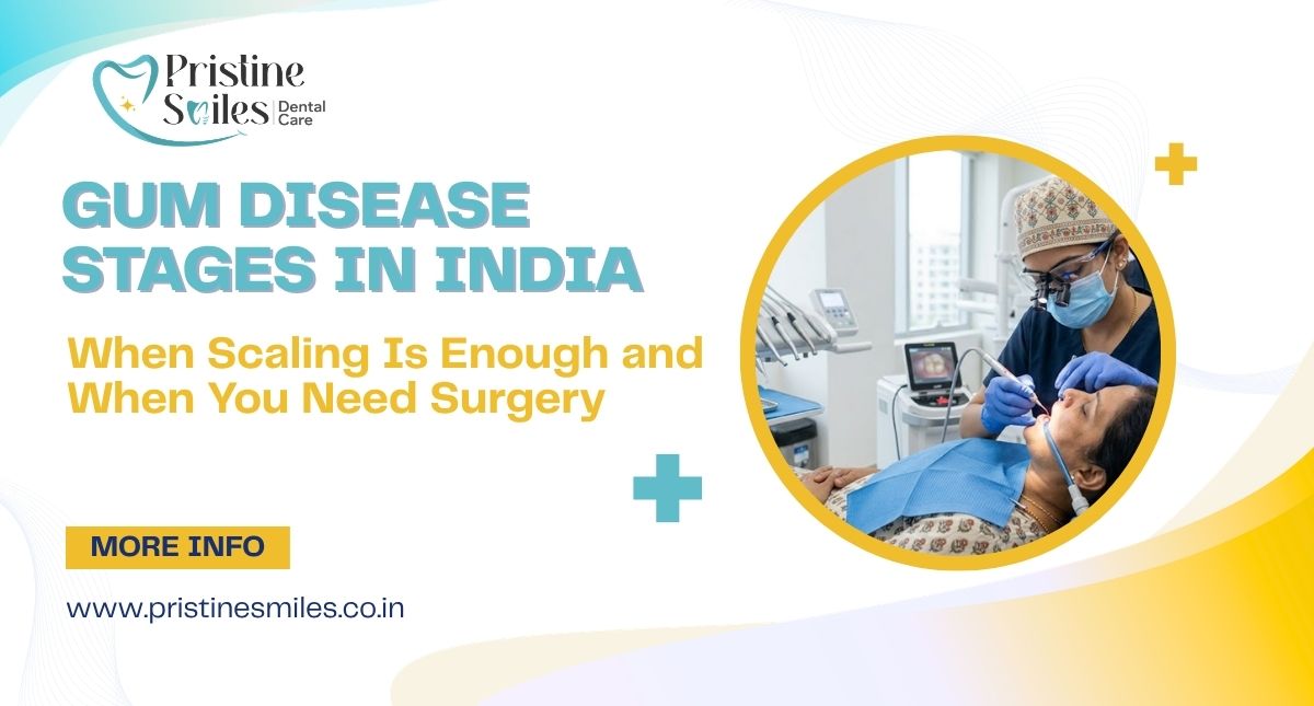 Gum Disease Stages in India
