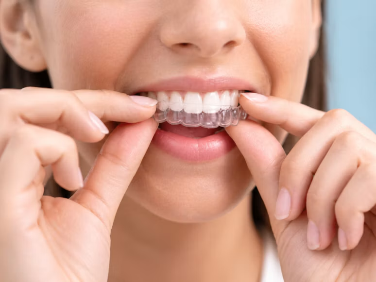 Teeth Invisible Aligners