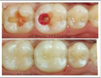 Root Canal Treatment