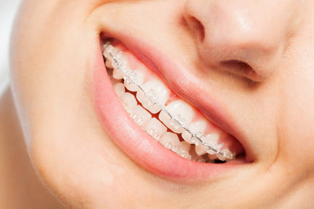 Invisible Braces